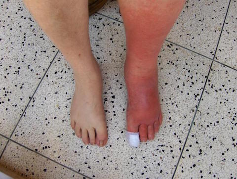 写真:蜂窩織炎(浮腫あり)Author: Author:ColmAnderson on en.wikipedia.org Copied from http://en.wikipedia.org/wiki/Image:Cellulitis_Left_Leg.JPG29th October 2006