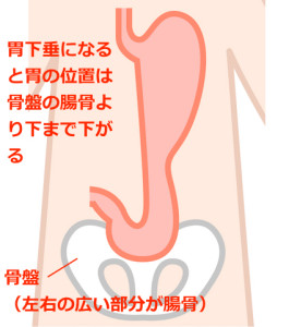 胃下垂解説図
