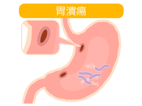 胃潰瘍イメージ